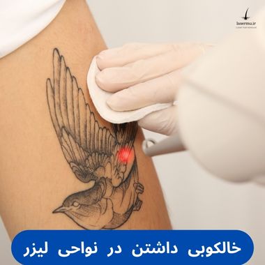 خالکوبی داشتن در بدن و در نواحی لیزر