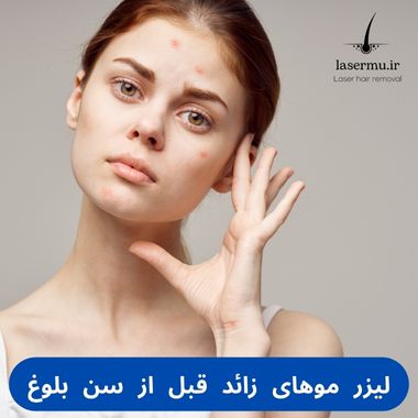 لیزر موهای زائد قبل از سن بلوغ