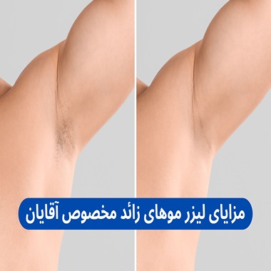 مزایای لیزر موهای زائد آقایان