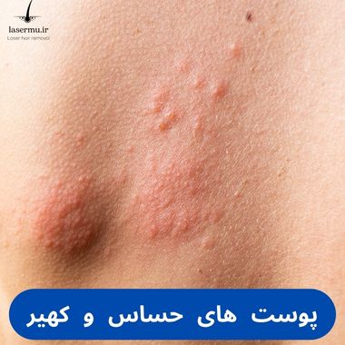 پوست های حساس و کهیر