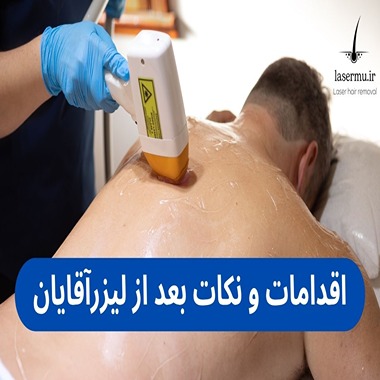 اقدامات و نکات بعد از لیزر درمانی برای آقایان